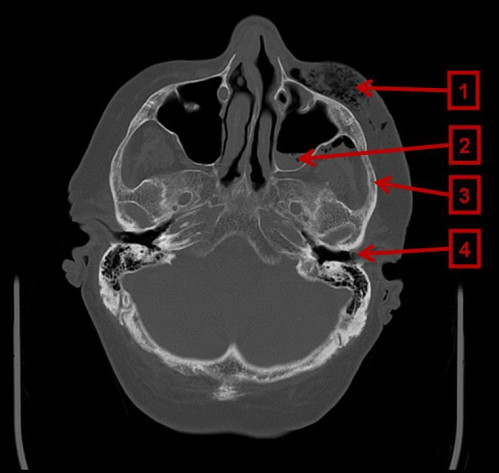 Bildgebung - CT axial präoperativ