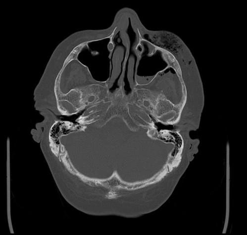 Bildgebung - CT axial präoperativ