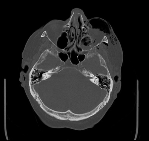 Bildgebung - CT axial präoperativ