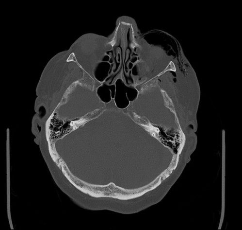 Bildgebung - CT axial präoperativ