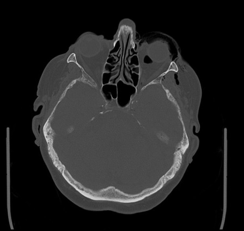Bildgebung - CT axial präoperativ