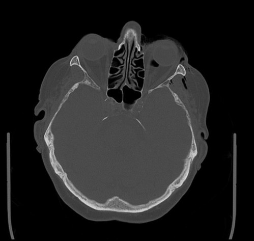 Bildgebung - CT axial präoperativ