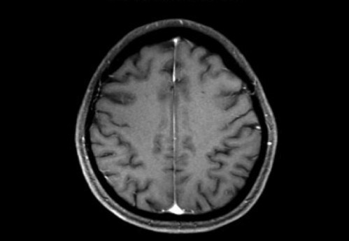 Bildgebung - MRT T1 + Gadolinium