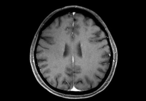 Bildgebung - MRT T1 + Gadolinium