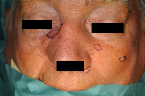 Makroskopie - Gesicht intraoperativ
