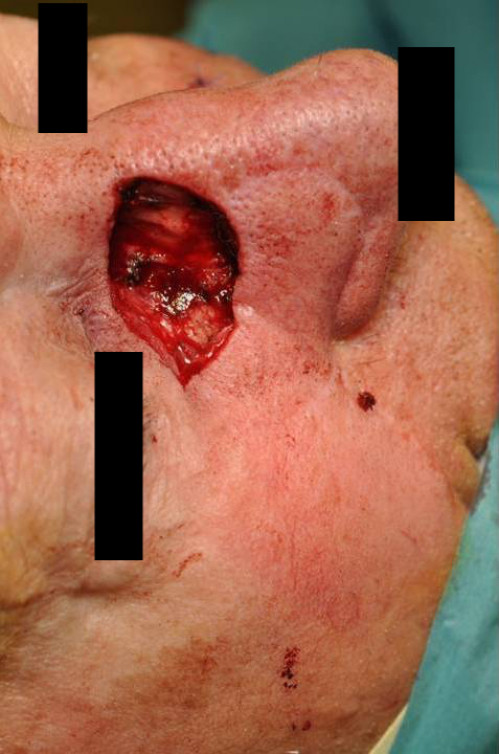 Makroskopie - Gesicht intraoperativ