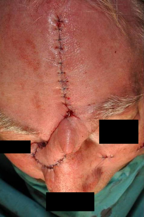 Makroskopie - Gesicht intraoperativ