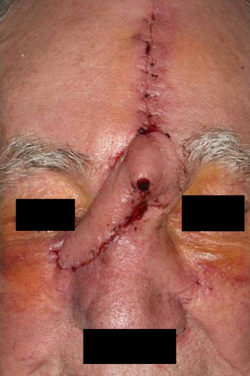 Makroskopie - Gesicht postoperativ