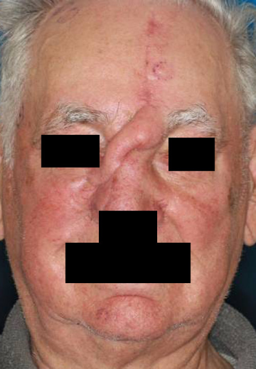 Makroskopie - Gesicht postoperativ