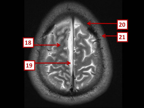 Bildgebung - MRT T2 axial nummeriert