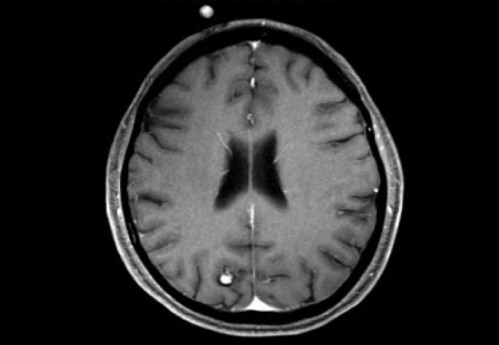 Bildgebung - MRT T1 + Gadolinium