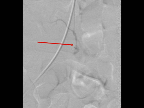 Bildgebung - Angiografie Sequenz postinterventionell