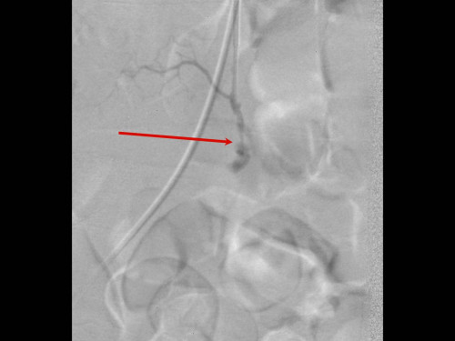 Bildgebung - Angiografie Sequenz postinterventionell
