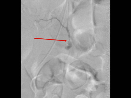 Bildgebung - Angiografie Sequenz postinterventionell