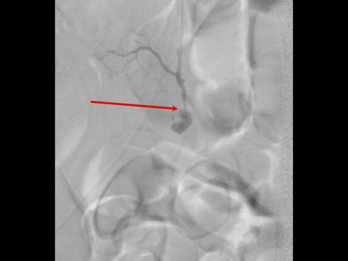 Bildgebung - Angiografie Sequenz postinterventionell