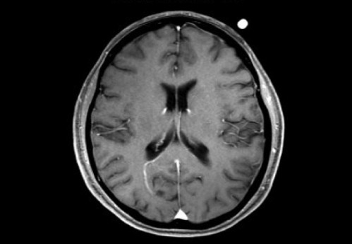 Bildgebung - MRT T1 + Gadolinium