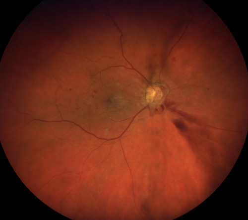 Zucker ins Auge_1