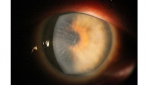Endotheldystrophie