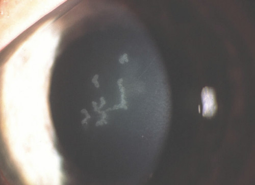 Herpes dendritica