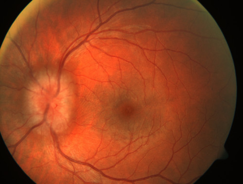 Retrobulbärer Tumor