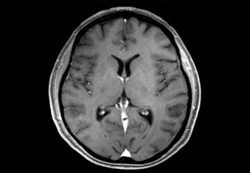 Bildgebung - MRT T1 + Gadolinium