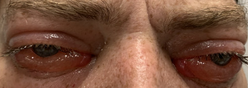 Allergische Konjunktivitis
