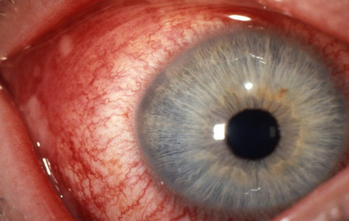 Konjunktivitis