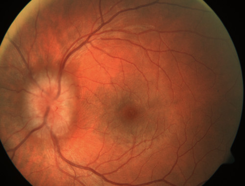 Retrobulbärer Tumor