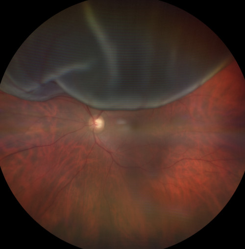Ablatio retinae