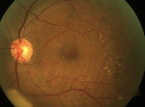 Diabetische Retinopathie