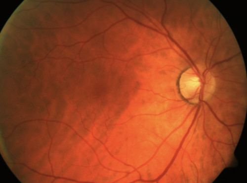 Normaler Fundus