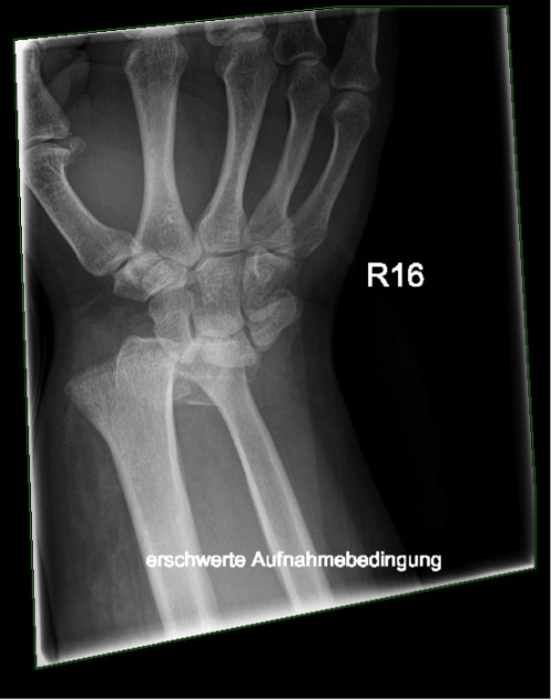 Röntgen distaler Unterarm mit Handgelenk anterior/posterior rechts
