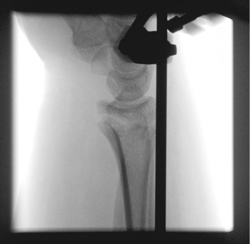 Röntgen intraoperativ