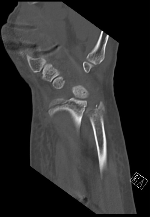CT Handgelenk anterior/posterior Schnitt 1