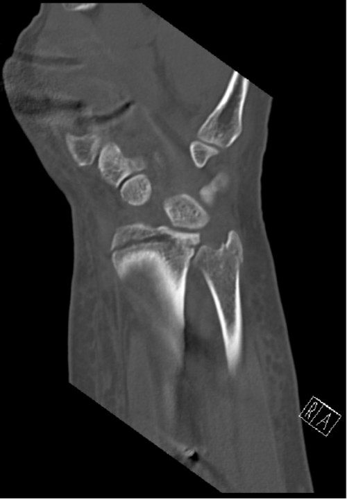 CT Handgelenk anterior/posterior Schnitt 2