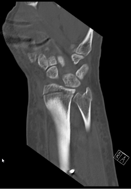 CT Handgelenk anterior/posterior Schnitt 3