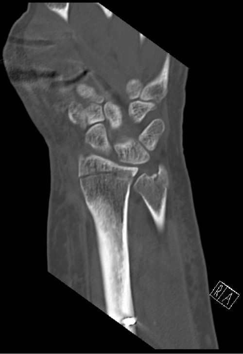 CT Handgelenk anterior/posterior Schnitt 4