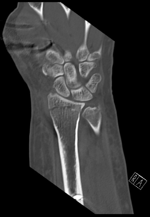 CT Handgelenk anterior/posterior Schnitt 5
