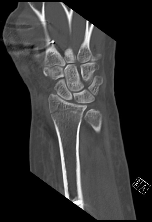 CT Handgelenk anterior/posterior Schnitt 6
