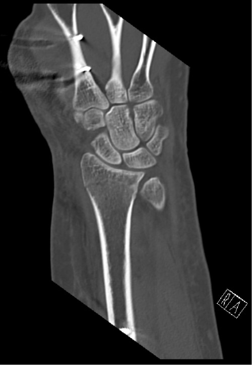 CT Handgelenk anterior/posterior Schnitt 7