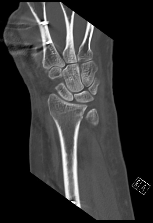 CT Handgelenk anterior/posterior Schnitt 8