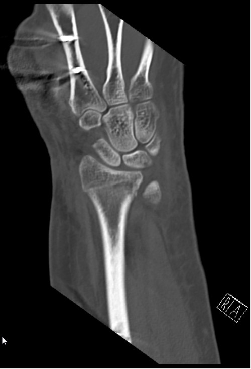 CT Handgelenk anterior/posterior Schnitt 9