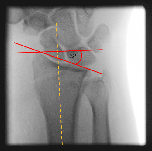 Böhler Winkel von anterior/posterior