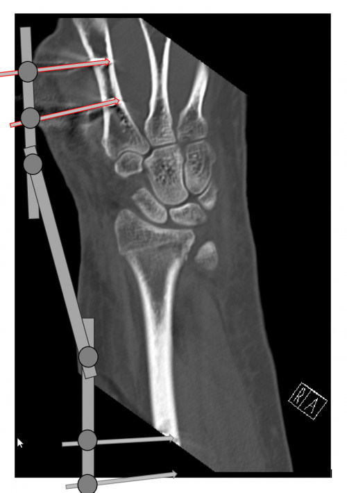 CT Handgelenk Fixateur externe schematisch