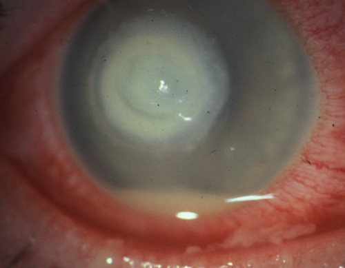 Hypopyon