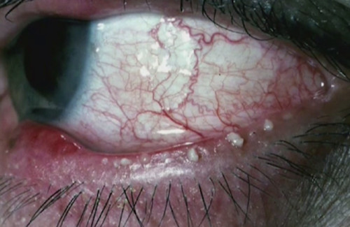 Blepharitis