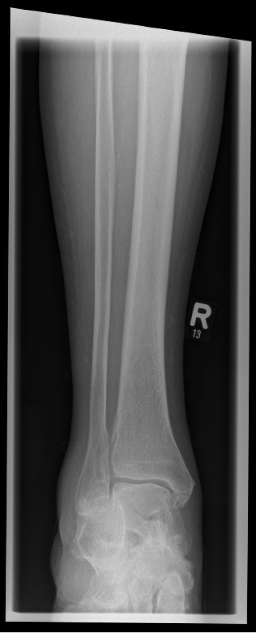 Röntgen distaler Unterschenkel mit OSG rechts anterior/posterior