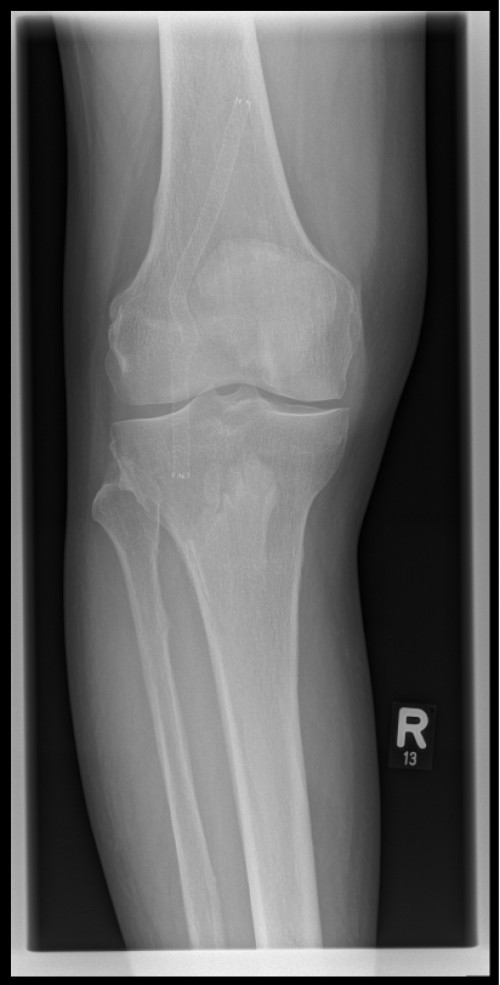 Röntgen proximaler Unterschenkel mit Knie rechts anterior/posterior
