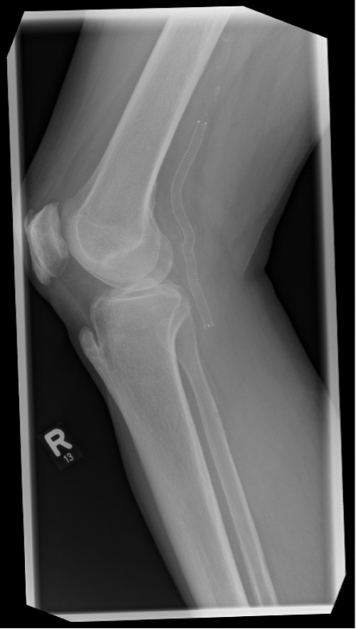 Röntgen proximaler Unterschenkel mit Knie rechts seitlich