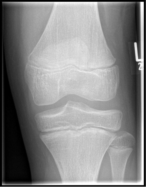 Röntgen 1 Knie links